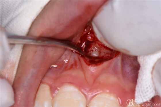 雙切口拔除鼻底埋伏多生牙