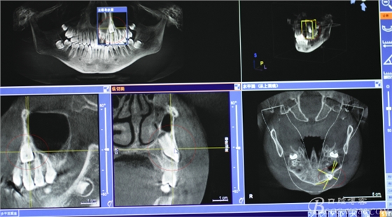 CBCT可以使拔牙更微創(chuàng)