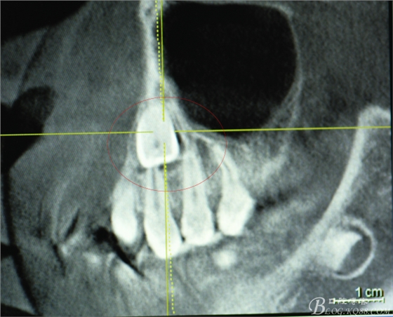 CBCT可以使拔牙更微創(chuàng)