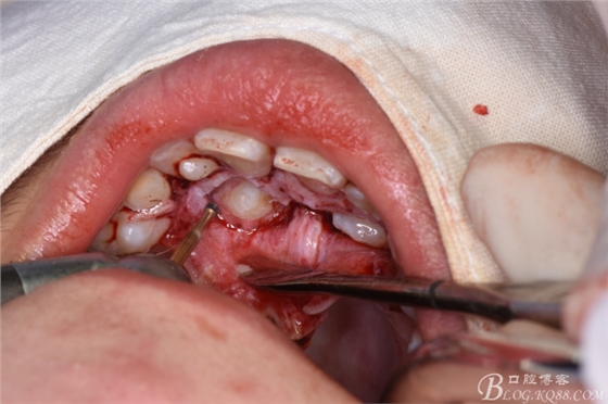 腭側(cè)開窗牽引雙側(cè)埋伏尖牙