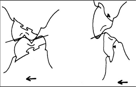 修復(fù)進(jìn)修醫(yī)生常見(jiàn)問(wèn)題（全口義齒）-圖8-1.bmp