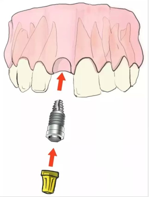 種植【最全的種植牙介紹】