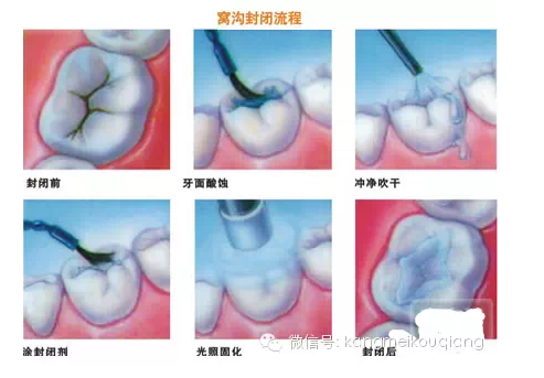 口腔窩溝封閉，就如同給牙齒穿上了一層保護(hù)衣，使牙齒免受食物侵蝕。原理：窩溝封閉后，窩溝內(nèi)原有的細(xì)菌斷。