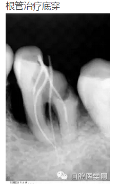 幾張失敗的根管治療x線診斷