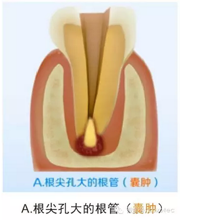 讓你知道根管測量受影響的原因