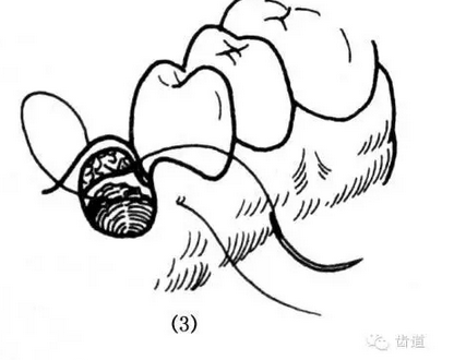 牙醫(yī)基本技能：口內(nèi)縫合術(shù)（文字、示意圖及視頻）