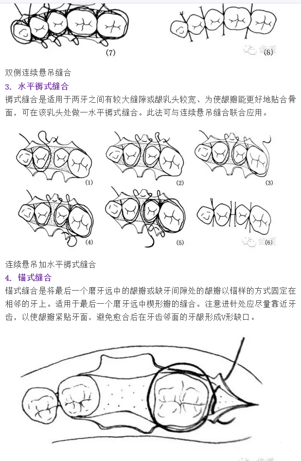 牙醫(yī)基本技能：口內(nèi)縫合術(shù)（文字、示意圖及視頻）