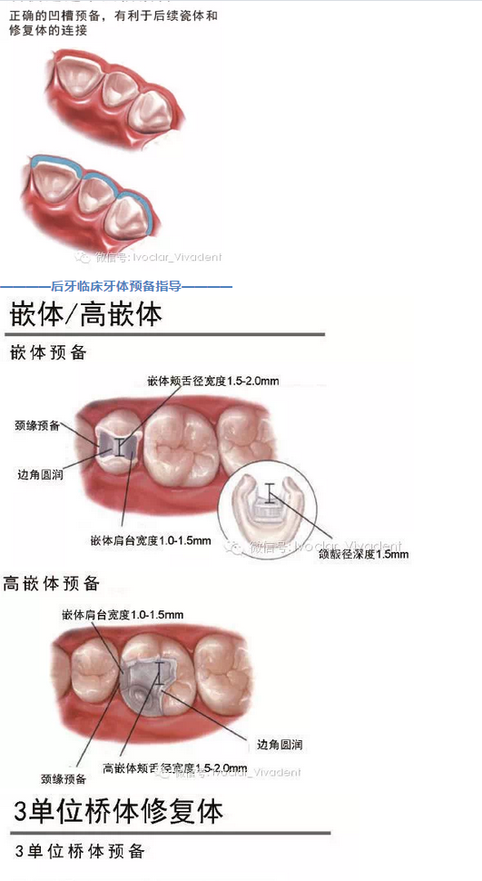 時(shí)常搞不清楚怎么備牙嗎？義獲嘉教您如何完美備牙