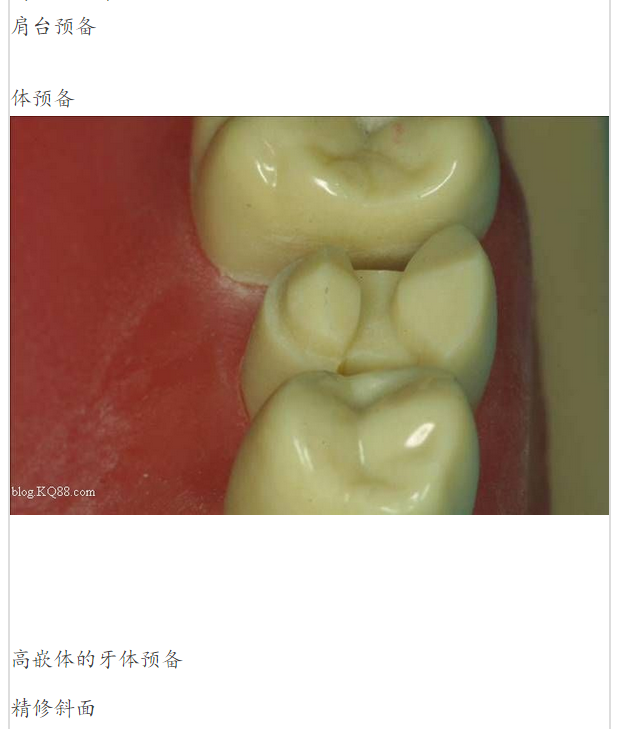 嵌體牙體預(yù)備方法