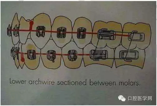 正畸damon system橡皮筋(elastics)掛法示意圖