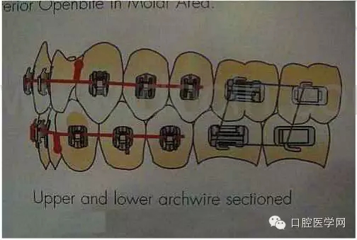 正畸damon system橡皮筋(elastics)掛法示意圖