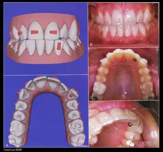 解決牙齒不齊的十八般武器