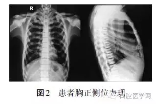 頜骨骨髓炎X線影像