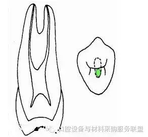 超實(shí)用的根管口的探查術(shù)