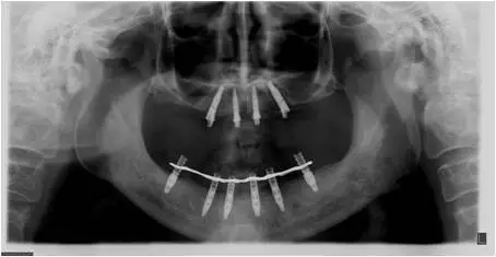 All-on-4上頜種植失敗一例及處理方法解析 