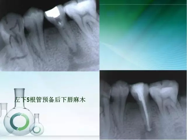 根管治療并發(fā)癥及處理