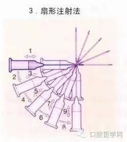 即使是老手也會失手的麻醉----下牙槽、舌、頰一次阻滯麻醉