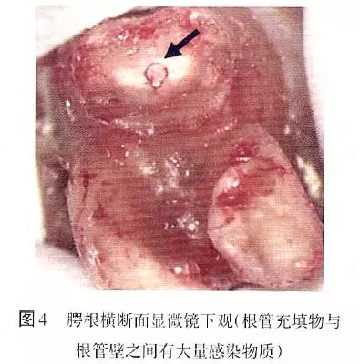 根管治療