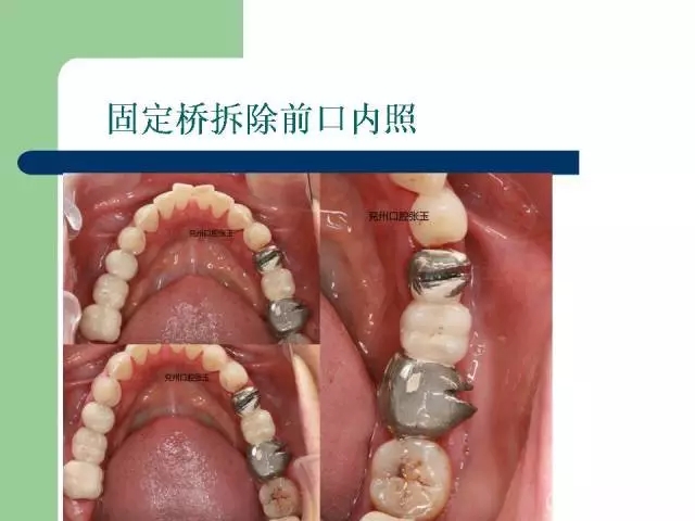 左下后牙不良修復(fù)體拆除后重新修復(fù)一例