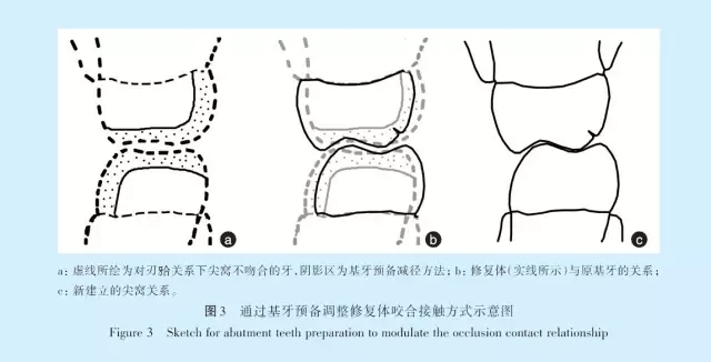 王美青.淺談咬合修復(fù)重建中的（牙合）學(xué)問(wèn)題