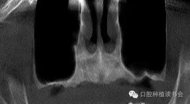 上頜后牙區(qū)種植治療的關(guān)鍵技術(shù)之—上頜竇提升術(shù)