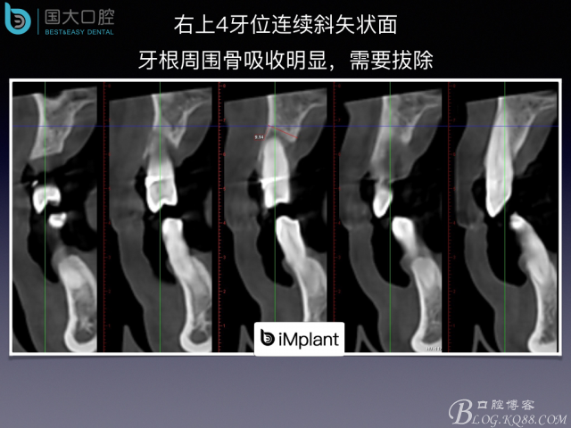 上頜竇底區(qū)域嚴(yán)重骨吸收的臨床種植案例.jpeg