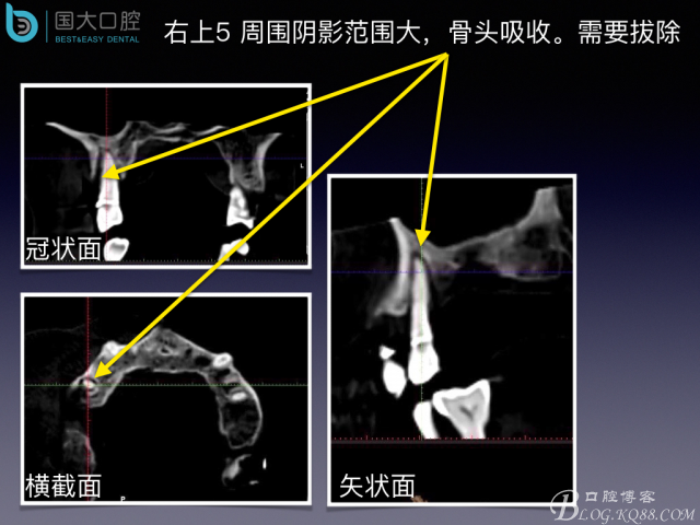 上頜竇底區(qū)域嚴(yán)重骨吸收的臨床種植案例.jpeg