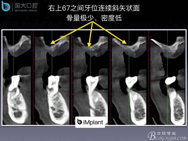 上頜竇底區(qū)域嚴(yán)重骨吸收的臨床種植案例.jpeg