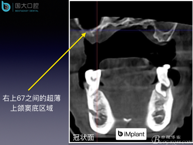 上頜竇底區(qū)域嚴(yán)重骨吸收的臨床種植案例.jpeg