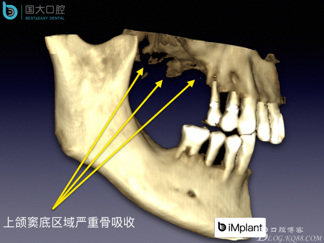 上頜竇底區(qū)域嚴(yán)重骨吸收的臨床種植案例.jpeg