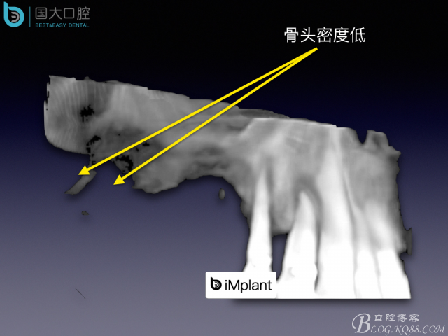 上頜竇底區(qū)域嚴(yán)重骨吸收的臨床種植案例.jpeg