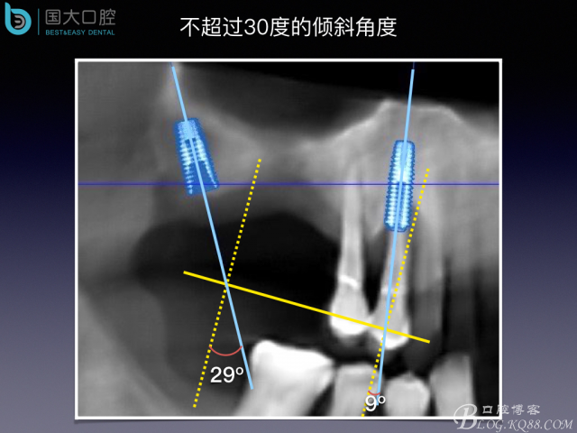 上頜竇底區(qū)域嚴(yán)重骨吸收的臨床種植案例.jpeg