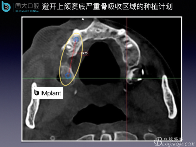 上頜竇底區(qū)域嚴(yán)重骨吸收的臨床種植案例.jpeg