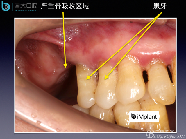 上頜竇底區(qū)域嚴(yán)重骨吸收的臨床種植案例.jpeg