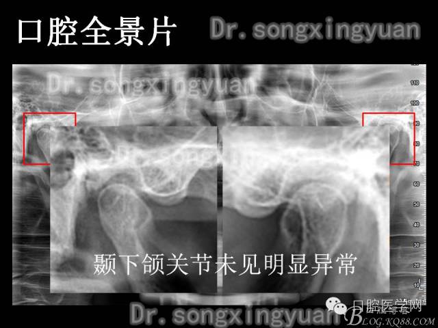 種植牙全口咬合重建