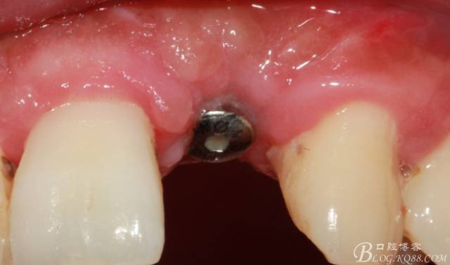 【征文大賽】一例上前牙種植失敗病例的補救--梁光強