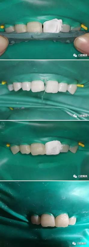 圖解：前牙間隙關(guān)閉過程