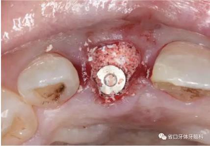 右上前牙即刻種植即刻修復(fù)1例