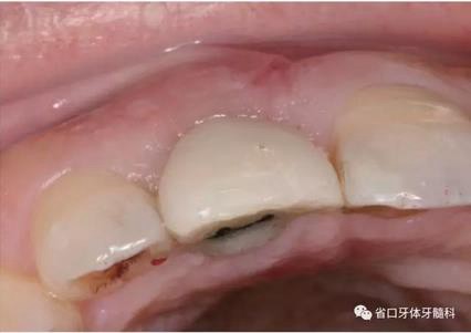 右上前牙即刻種植即刻修復(fù)1例