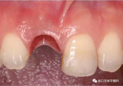 右上前牙即刻種植即刻修復(fù)1例