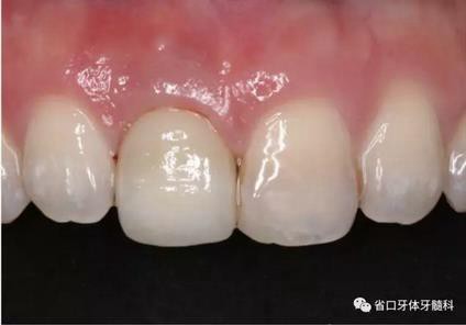 右上前牙即刻種植即刻修復(fù)1例