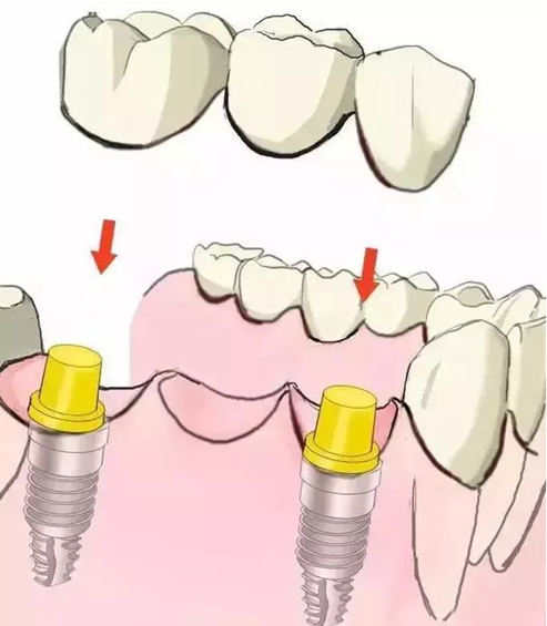 圖解：種牙與鑲牙的區(qū)別，缺牙的趕緊看.png