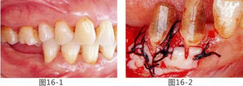 FGG法增大附著齦及根面覆蓋【牙齦－牙槽黏膜的問題】.png