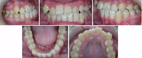 【病例展示】Smartee隱形正畸中國好病例鑒賞第三波