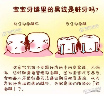 牙縫間的黑線是鄰面齲，還一壞壞倆，巧用它幫你渡過一“劫”