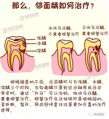 牙縫間的黑線是鄰面齲，還一壞壞倆，巧用它幫你渡過一“劫”