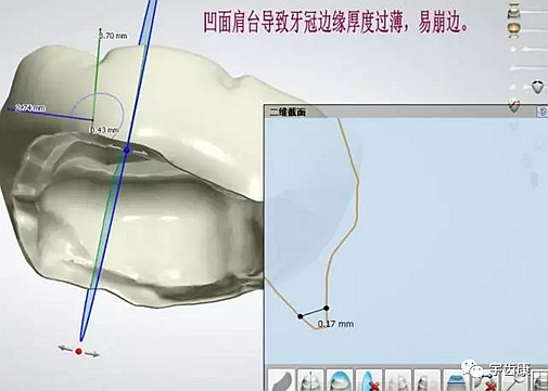 影響全瓷牙冠裂的因素有哪些？