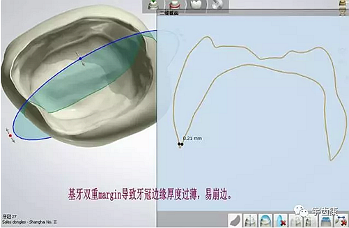 影響全瓷牙冠裂的因素有哪些？