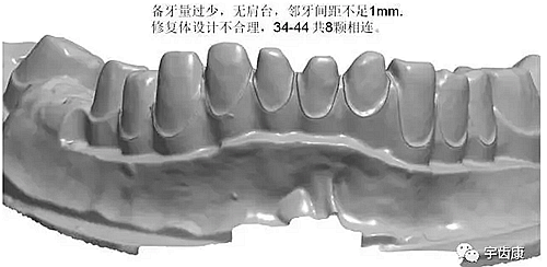 影響全瓷牙冠裂的因素有哪些？