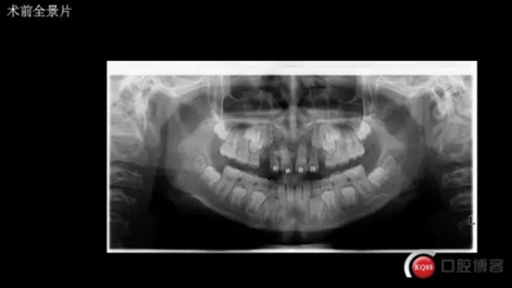 CBCT導航下多生牙拔除，混合牙列期矯正思考！